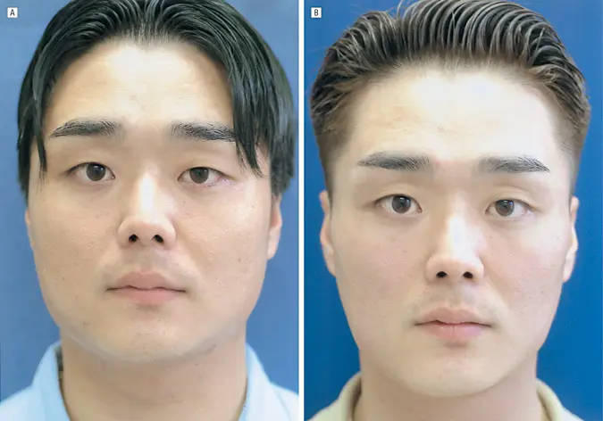 reduction in the masseter muscle size